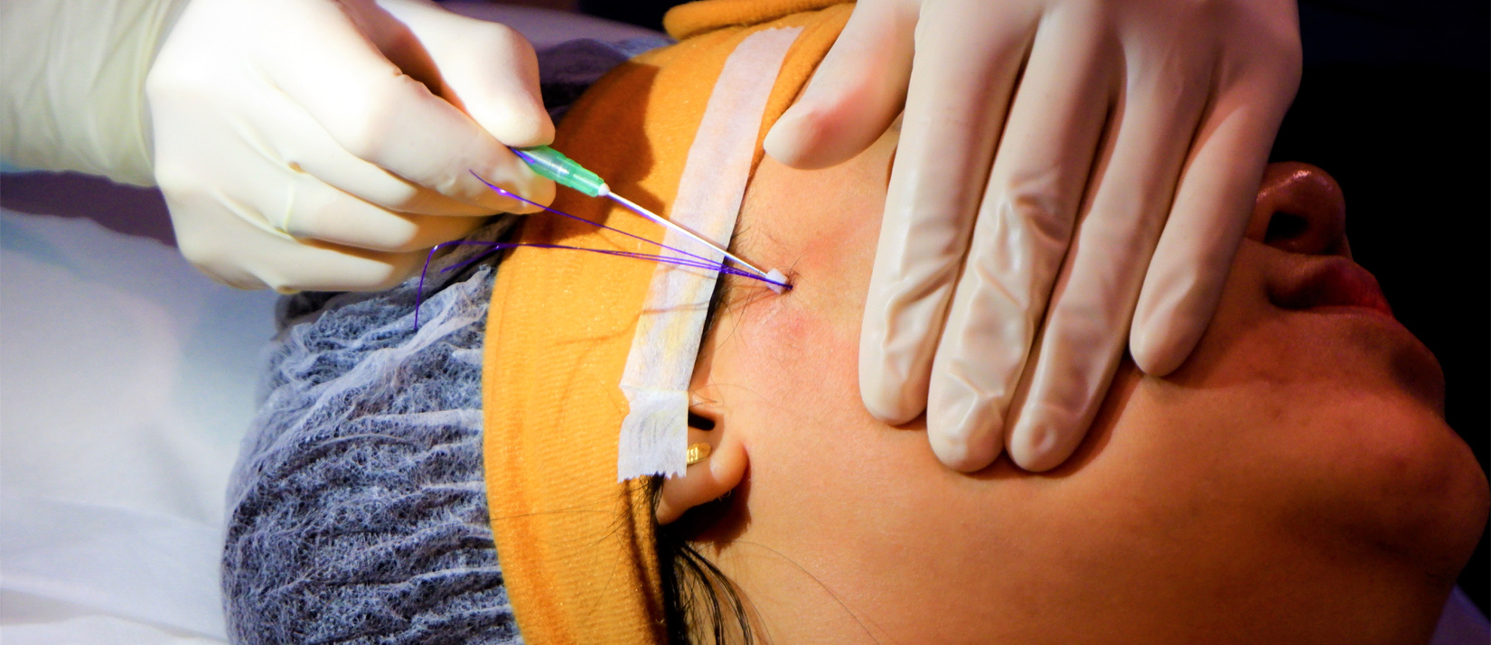 Advanced Training in Thread Lift and Scaffold